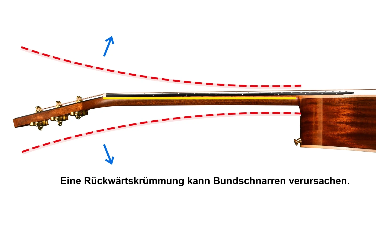 Eine Rückwärtskrümmung kann Bundschnarren verursachen.